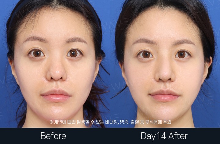 전후사진 30 페이지 | 웨이브의원