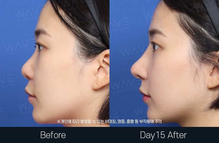 전후사진 30 페이지 | 웨이브의원