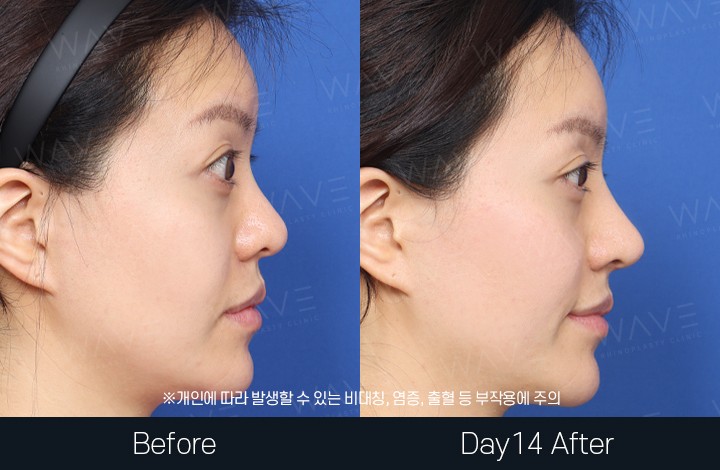 전후사진 30 페이지 | 웨이브의원